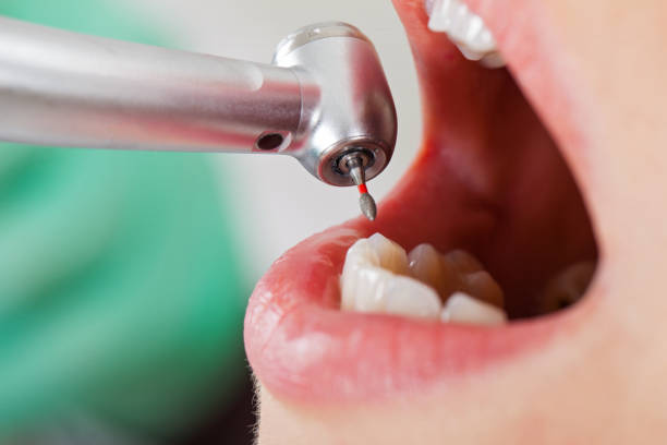 Best Emergency Root Canal Treatment in Boutte, LA